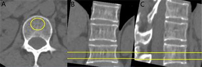 The value of radiomics to predict abnormal bone mass in type 2 diabetes mellitus patients based on CT imaging for paravertebral muscles